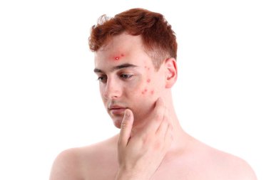 Beyaz arka planda sivilceli genç bir çocuk.