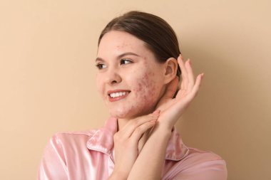 Bej arka planda sivilce sorunu olan genç bir kadın, yakın plan.