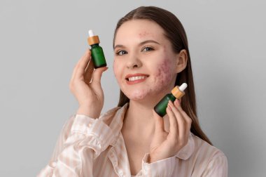 Sivilceli genç bir kadın ve arka planda bir şişe serum, yakın plan.