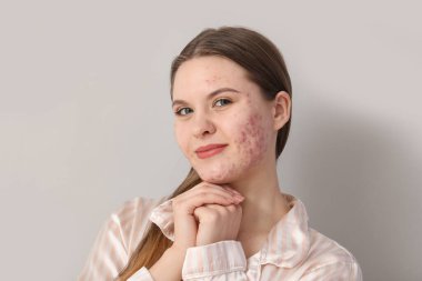 Hafif arka planda sivilce sorunu olan genç bir kadın, yakın plan.