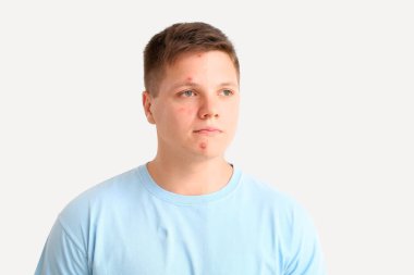 Beyaz arka planda sivilce tedavisinden önce ve sonra genç bir çocuğun portresi