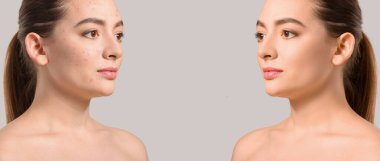 Açık arkaplanda akne tedavisi öncesi ve sonrası genç kadın 