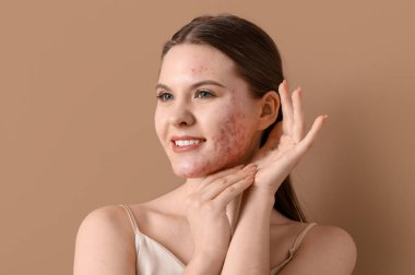 Kahverengi arka planda sivilce sorunu olan genç bir kadın, yakın plan.