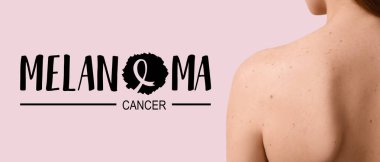 Köstebekleri olan ve pembe arka planda MELANOMA CANCER yazan genç bir kadın.