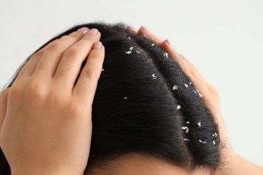 Beyaz arka planda kepek sorunu olan genç bir kadın, yakın plan.