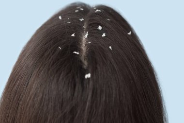 Young woman with dandruff problem on blue background, closeup clipart