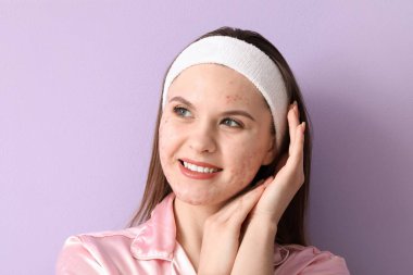 Leylak arka planında sivilce sorunu olan genç bir kadın, yakın plan.