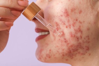 Sivilceli genç bir kadın leylak arka planına serum takıyor, yakın plan.