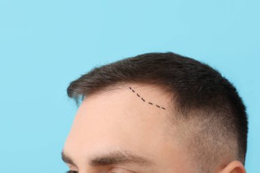 Saç dökülmesi sorunu ve alnında mavi arka planda izler olan genç adam, yakın plan.