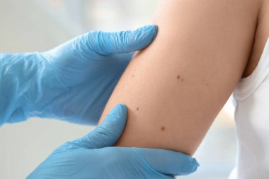 Dermatologist examining moles on young woman in clinic, closeup