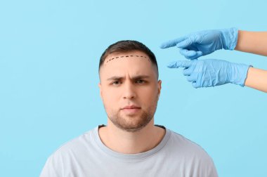 Doktor, mavi arka planda saç kaybı sorunu olan genç adamın alnındaki izlere işaret ediyor.