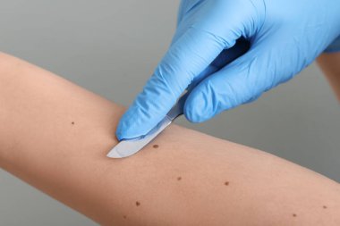 Kadının kolunda neşter ve ben olan bir cerrah yeşil arka planda, yakın plan.