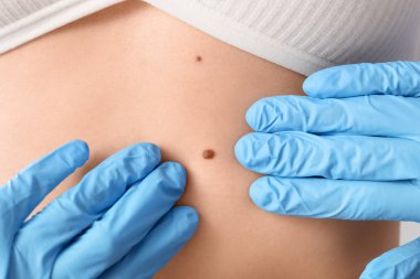 Dermatolog kadının karnındaki beni inceliyor, yakın plan.