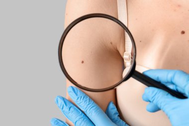 Cildiyeci kadının omzundaki benleri gri arkaplanla karşılaştırıyor, yakın plan.