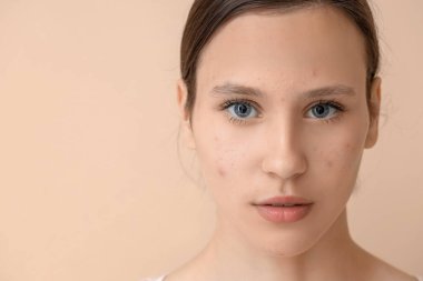 Bej arka planda sivilce sorunu olan güzel bir genç kadın.