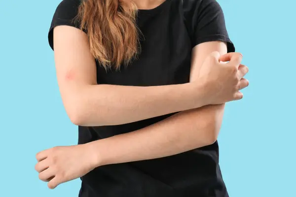 stock image Young woman with mosquito bite itching on blue background, closeup