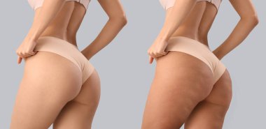 Gri arka planda selülit tedavisi öncesi ve sonrası genç kadın vücudu