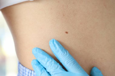 Dermatologist examining moles on young woman in clinic, closeup