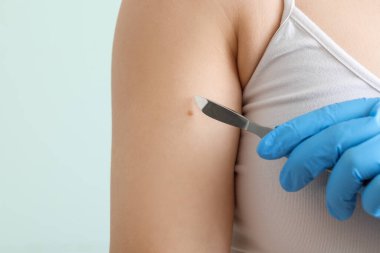 Kadının kolunda neşter ve ben olan bir cerrah yeşil arka planda, yakın plan.