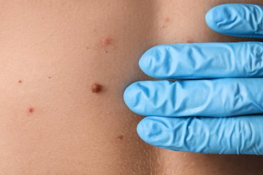 Dermatolog kadının sırtındaki benleri inceliyor, yakın plan.