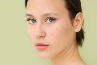 Beautiful young woman with acne problem on green background clipart