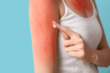 Kırmızı güneş yanığı tenli alerjik genç kadın mavi arka planda krem sürüyor.