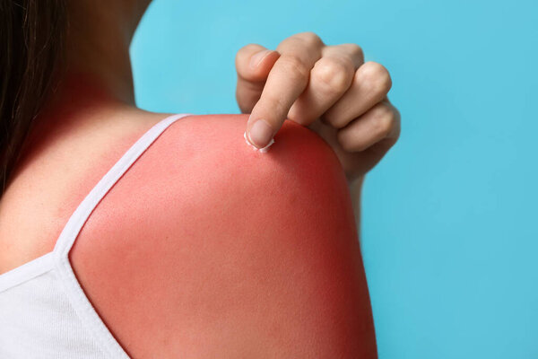 Аллергия молодая женщина с красной обгорелой кожей нанесения крема на синий фон, крупным планом