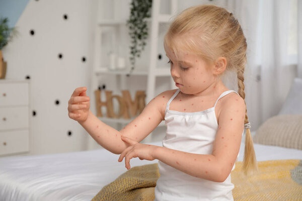Little girl ill with chickenpox in bedroom