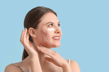 Sivilceli genç bir kadın ve mavi arka planda göz altı kremi, yakın plan.