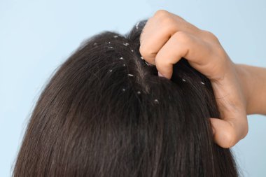 Kepek sorunu olan genç bir kadın mavi arka planda kafasını kaşıyor, yakın plan.