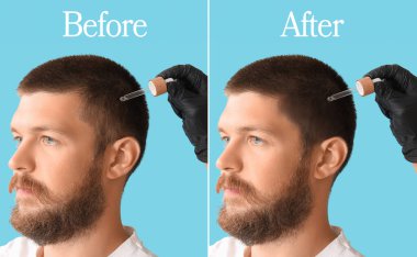 Açık mavi arka planda saç dökülmesi öncesi ve sonrası tedavi