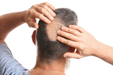 Beyaz arka planda saç dökülmesi sorunu olan olgun bir adam. 