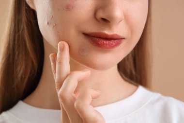 Sivilce sorunu olan genç bir kadın ve bej arka planda sivilce bantları var. Yakın plan.