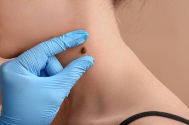 Dermatolog bej arka planda hastanın mol incelemesi yapıyor.