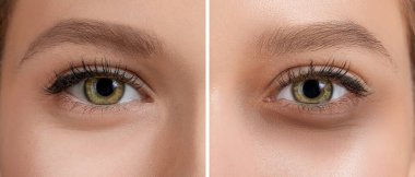 Comparison of young woman with and without dark circle under eye, closeup clipart