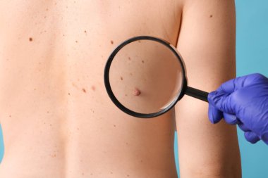 Dermatolog, büyüteçle kadının sırtındaki benleri mavi arka planda inceliyor, yakın plan.