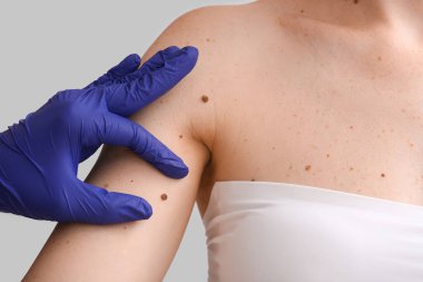 Cildiyeciler kadının omzundaki benleri ışığa karşı inceliyor, yakın plan.