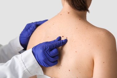 Dermatolog klinikte kadının sırtındaki benleri inceliyor.