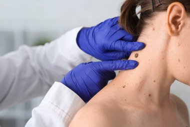 Dermatolog klinikte kadının boynundaki beni inceliyor.