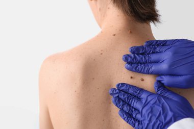 Dermatolog klinikte kadının sırtındaki benleri inceliyor.