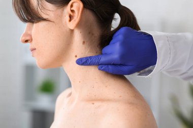 Dermatolog klinikte kadının boynundaki benleri inceliyor.