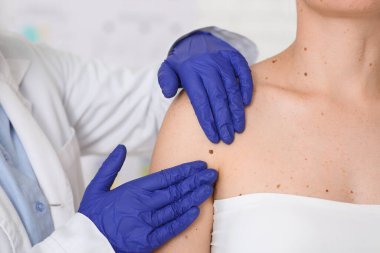 Dermatolog klinikte kadının vücudundaki beni inceliyor.