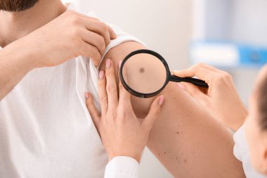 Dermatolog klinikteki erkek hastaların benlerini inceliyor. Yakın çekim.