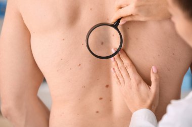 Dermatolog ve büyüteçle klinikteki erkek hastanın sırtındaki benleri inceliyor. Yakın çekim.