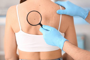 Dermatolog klinikte kadının sırtındaki benleri inceliyor. Yakın çekim.