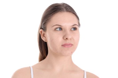 Beyaz arka planda sivilce sorunu olan genç kız, yakın plan.