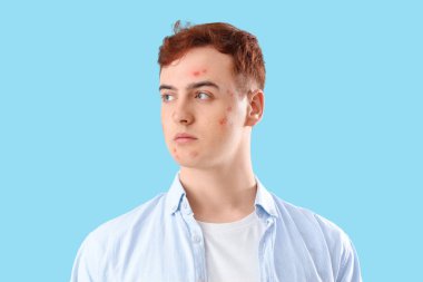 Mavi arka planda sivilceli genç bir çocuk.