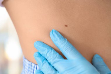 Dermatologist examining moles on young woman in clinic, closeup