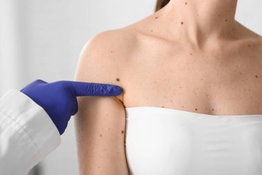 Dermatolog klinikte kadının omzundaki beni inceliyor.