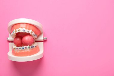 Diş telleri ve pembe arkaplan üzerinde çiğnenen diş etleri ile çene modeli